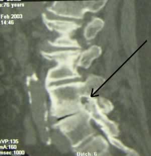 Le traitement endoscopique par foraminoplastie ostéoligamentaire ...