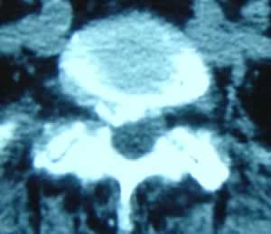 Le traitement endoscopique par foraminoplastie ostéoligamentaire ...