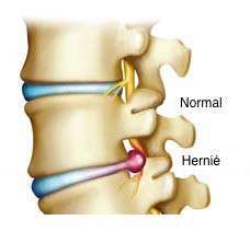 Hernie discale lombaire